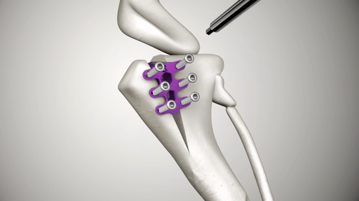 Titanium TTA Cages (Tibial Tuberosity Advancement) - Kit